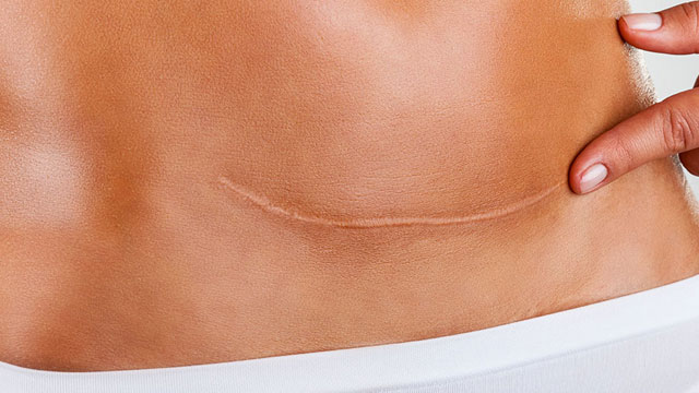 cicatriz tras una mini abdominoplastia