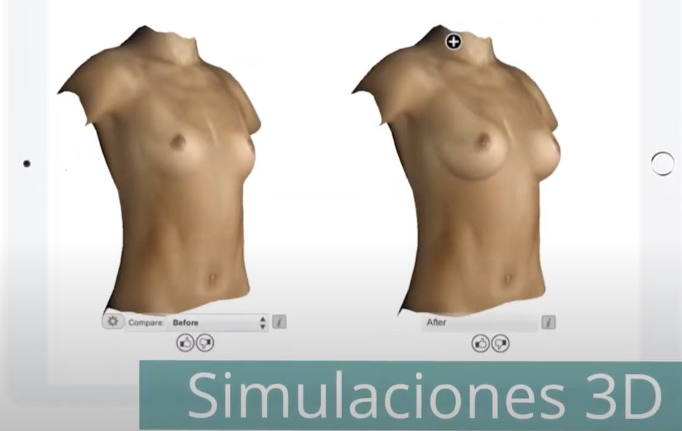 simulador 3D aumento de pecho