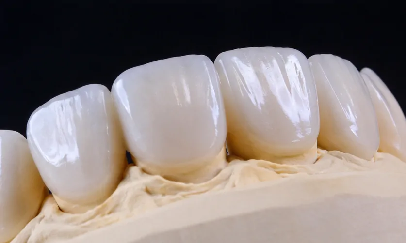 carillas dentales de porcelana o composite en Valencia